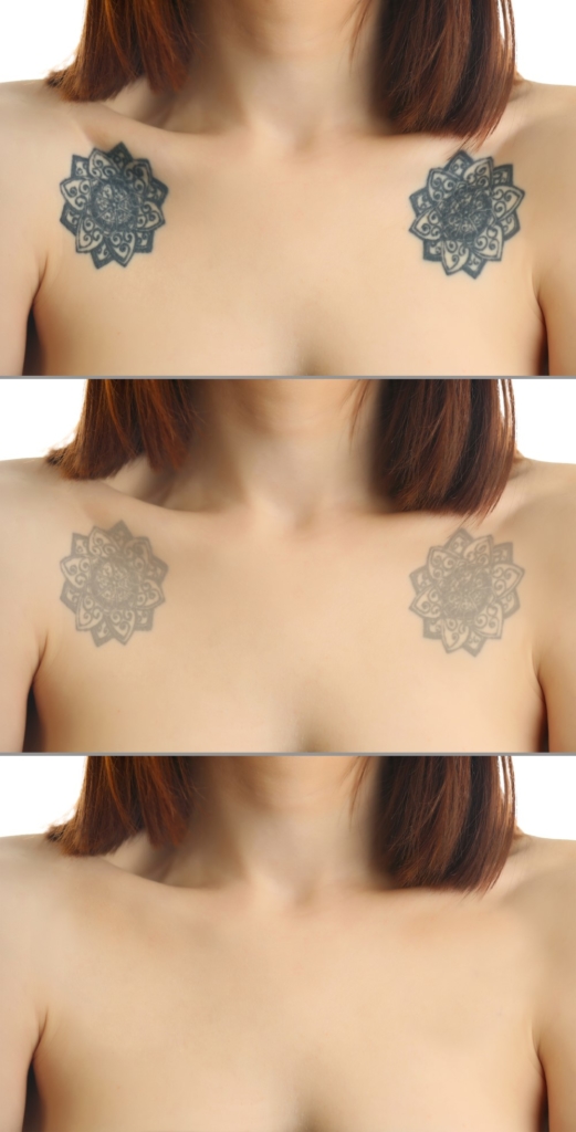 Tatoeage verwijderen met Gold Laser Q-Switched ND YAG QS-01