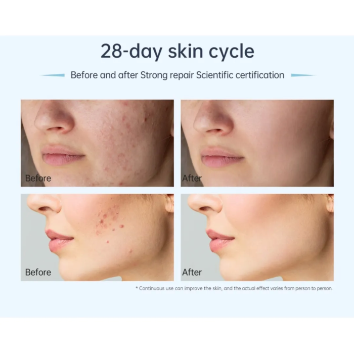 Dr. Pen A11 microneedling