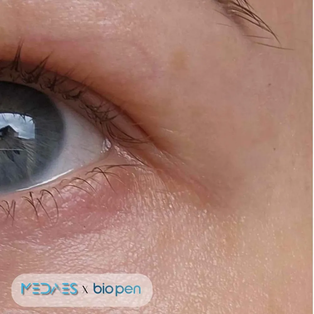 Microneedling met BioPen Q2 na een maand
