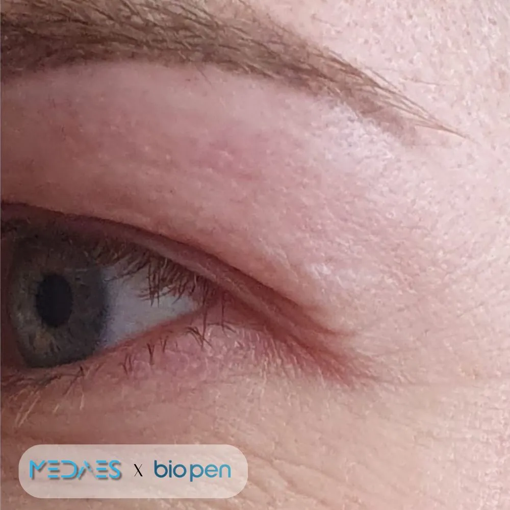 Microneedling met BioPen Q2 voor