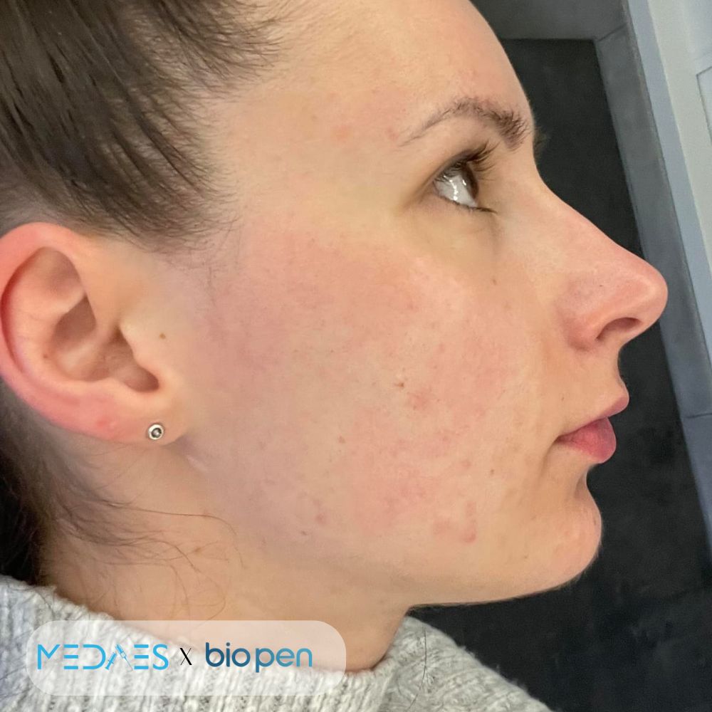 resultaten Bio Pen Q2 foto na acne