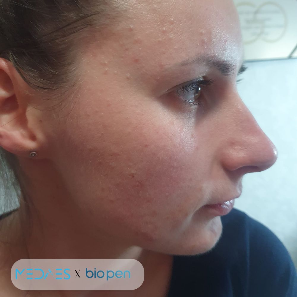 resultaten Bio Pen Q2 foto voor acne