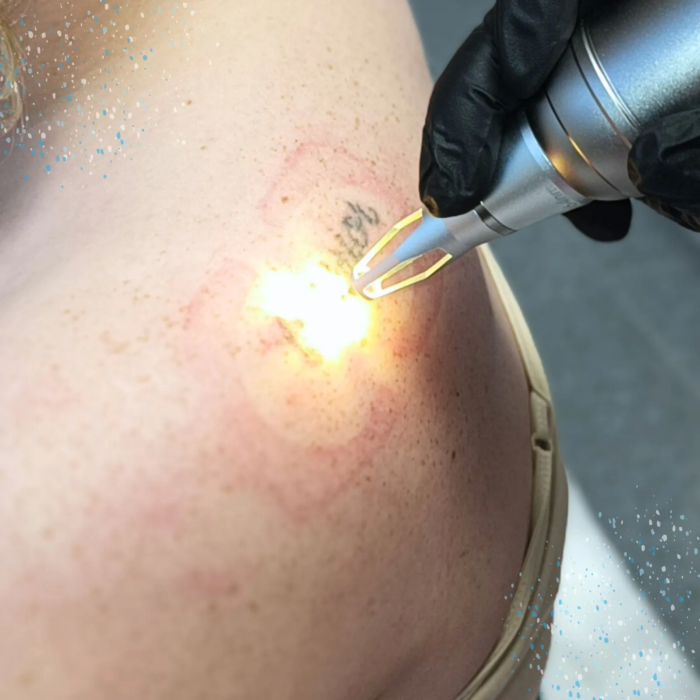 Tattoo verwijderen met de MA506B Picolaser 800W van MedAes Europe.