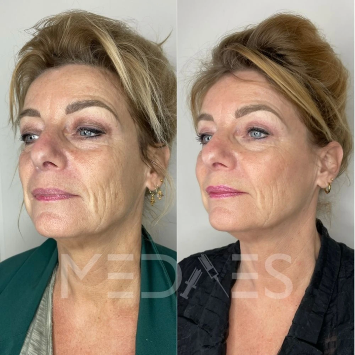 resultaten HIFU met MedAes HIFU 7D-Total Beauty Center-M01-na 5 maanden behandeling-02