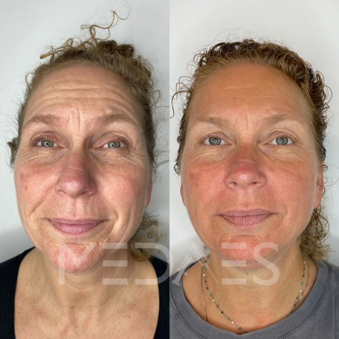 resultaten HIFU met MedAes HIFU 7D-Total Beauty Center-M02-na 5 maanden behandeling-02