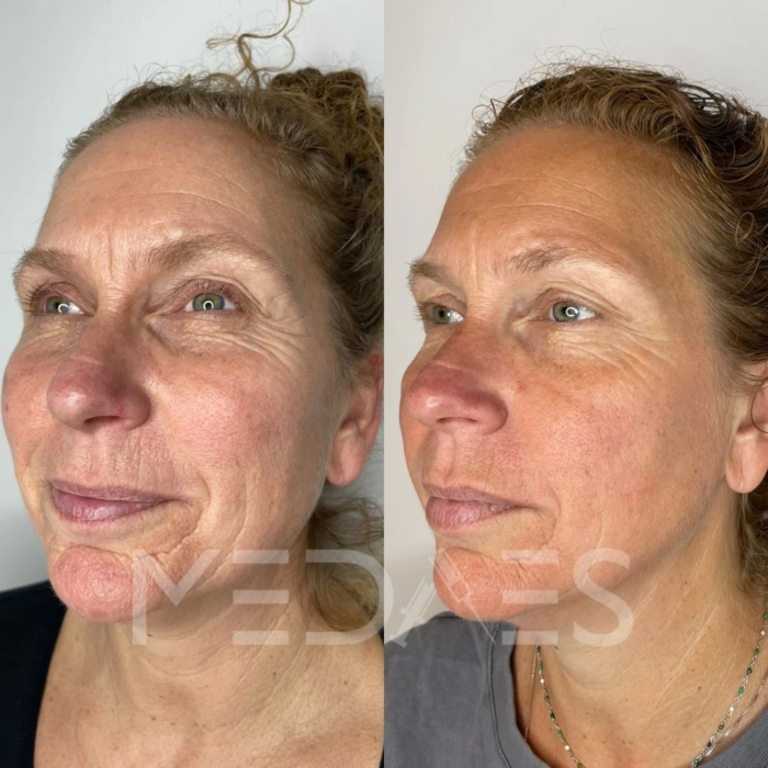 resultaten HIFU met MedAes HIFU 7D-Total Beauty Center-M02-na 5 maanden behandeling-04