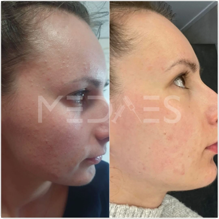 resultaten microneedling ACNE na 6 weken