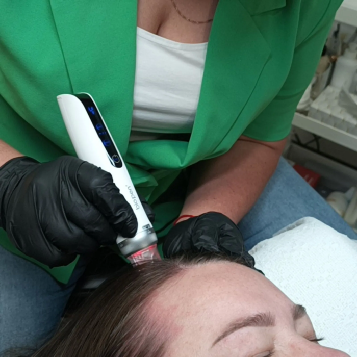 Dermelix Max Hair Meso 5ml serum voor haargroeistimulatie in situatie behandeling met BioPen Q2