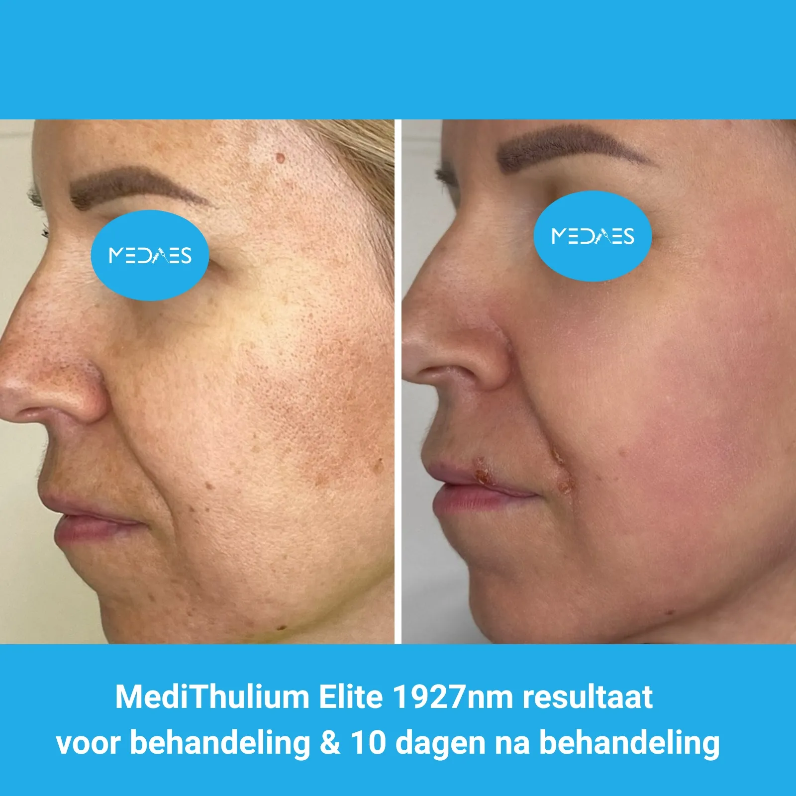 MediThulium Elite 1927nm van MedAes Europe resultaat voor behandeling & 10 dagen na behandeling melasma behandeling foto 3