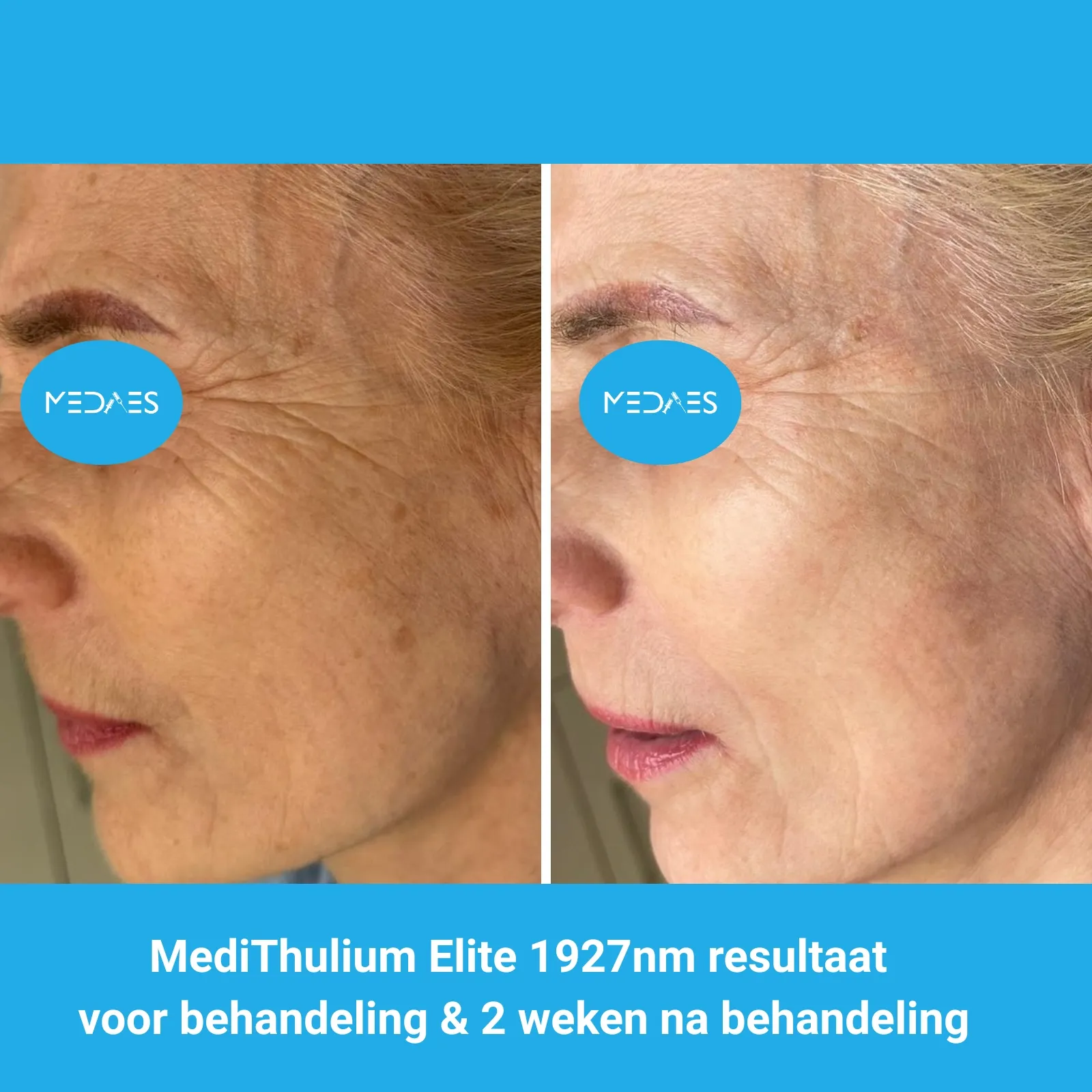 MediThulium Elite 1927nm van MedAes Europe resultaat voor behandeling & 2 weken na behandeling gezicht rejuvenation