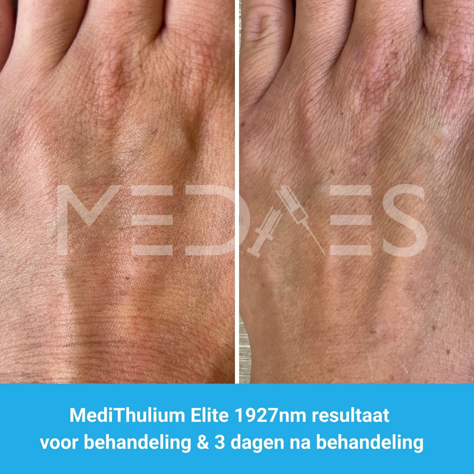 MediThulium Elite 1927nm van MedAes Europe resultaat voor behandeling & 3 dagen na behandeling hand rejuvenation foto 2