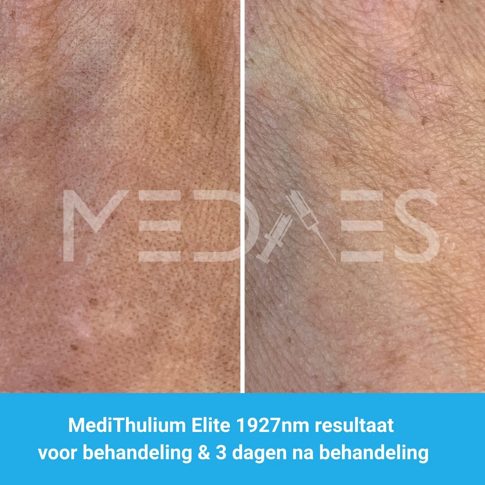 MediThulium Elite 1927nm van MedAes Europe resultaat voor behandeling & 3 dagen na behandeling hand rejuvenation