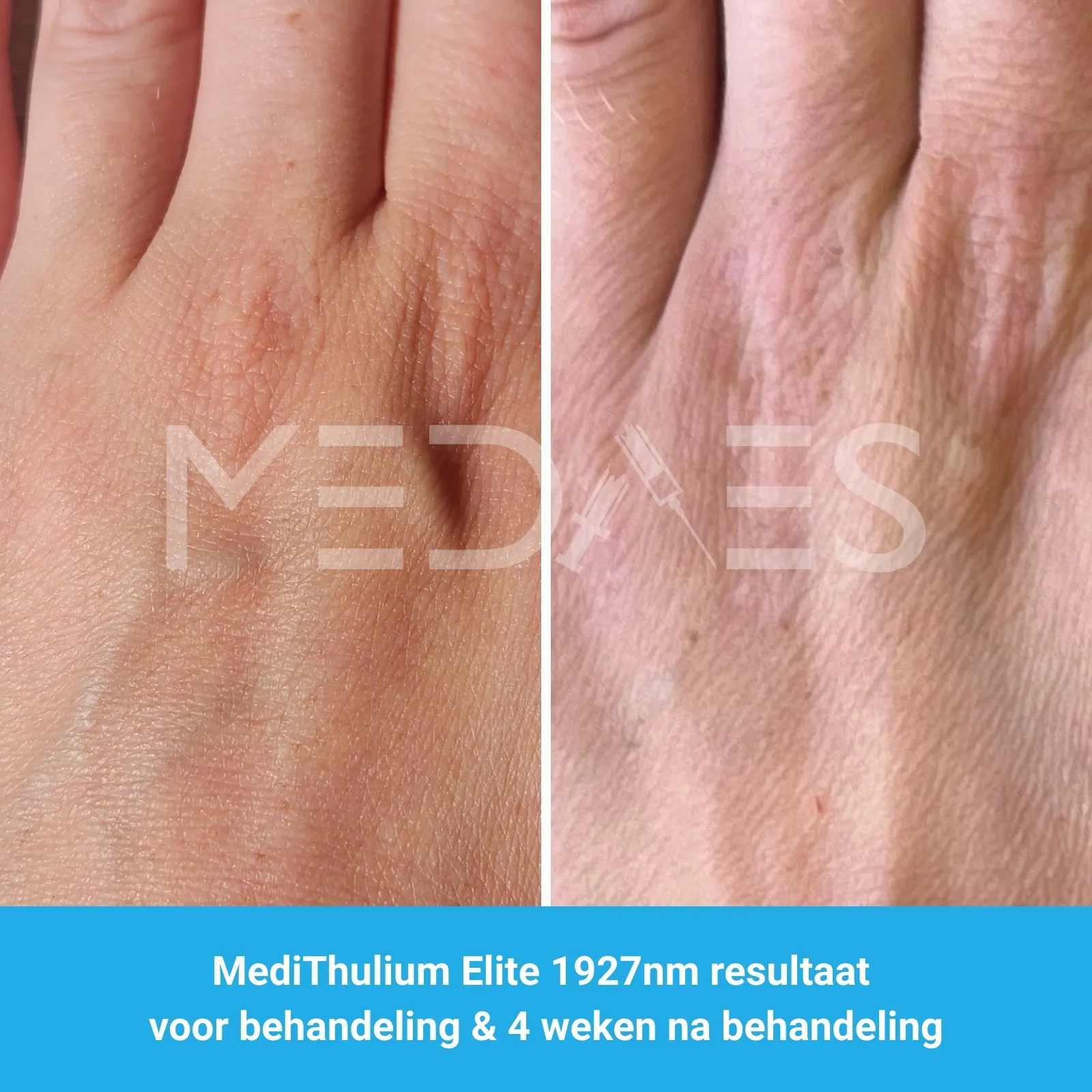 MediThulium Elite 1927nm van MedAes Europe resultaat voor behandeling & 4 weken na behandeling hand rejuvenation