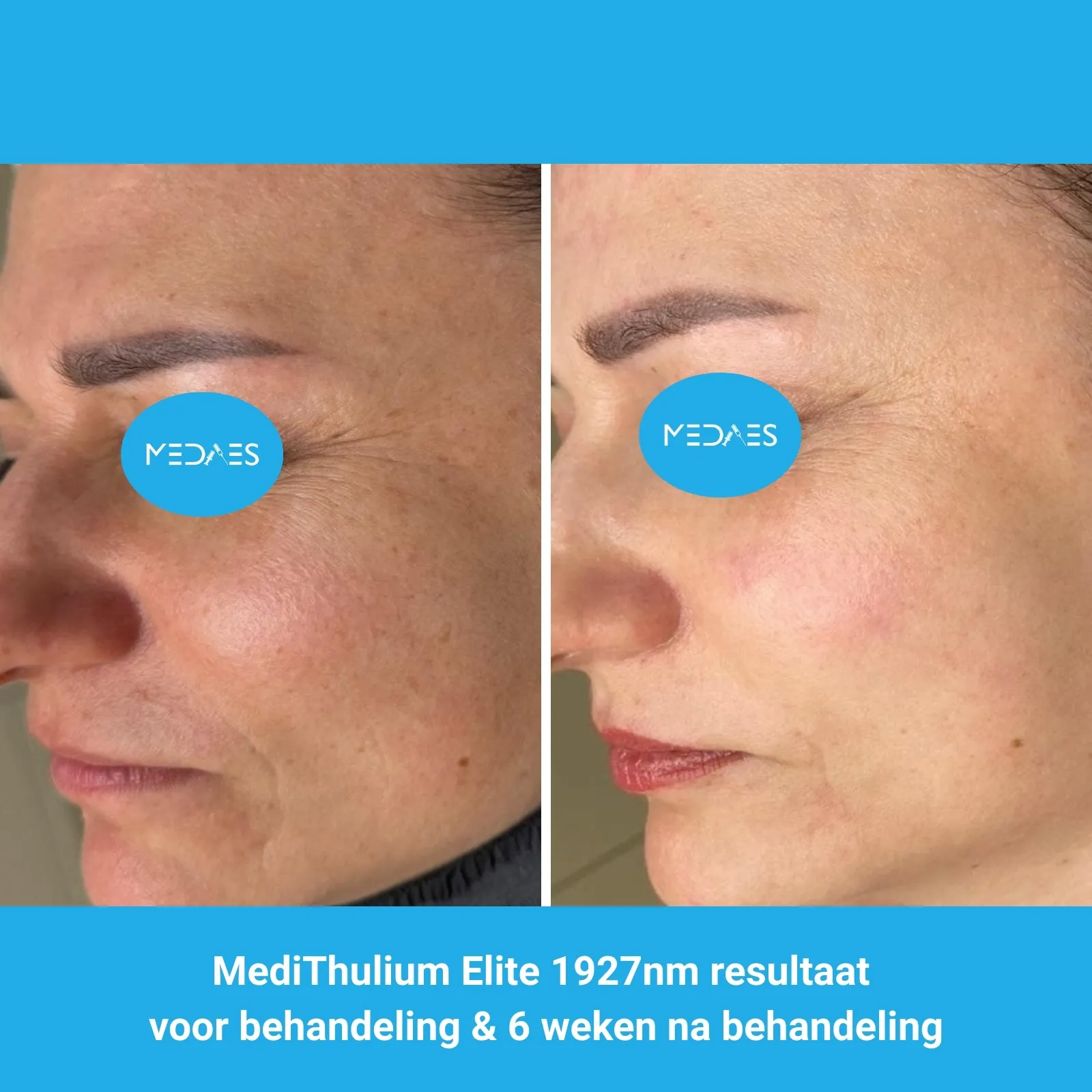 MediThulium Elite 1927nm van MedAes Europe resultaat voor behandeling & 6 weken na behandeling gezicht rejuvenation foto 2