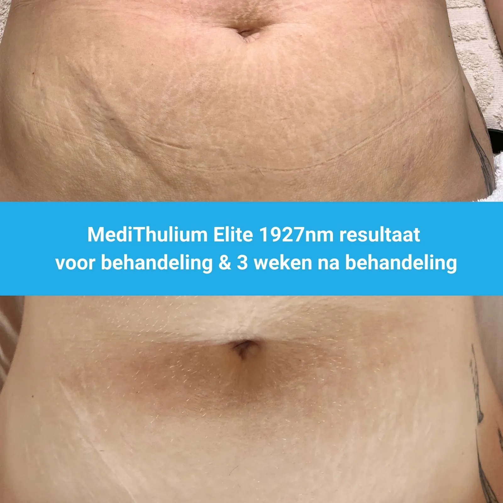 MediThulium Elite 1927nm van MedAes resultaat voor behandeling & 3 weken na behandeling striae behandeling