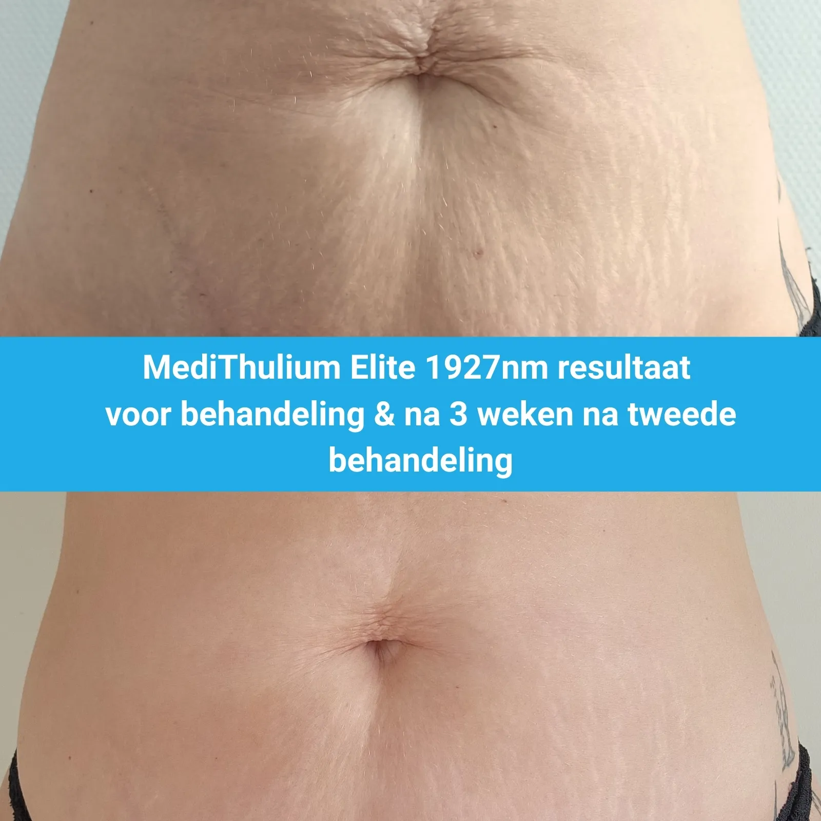MediThulium Elite 1927nm van MedAes resultaat voor behandeling & 3 weken na tweede behandeling striae behandeling