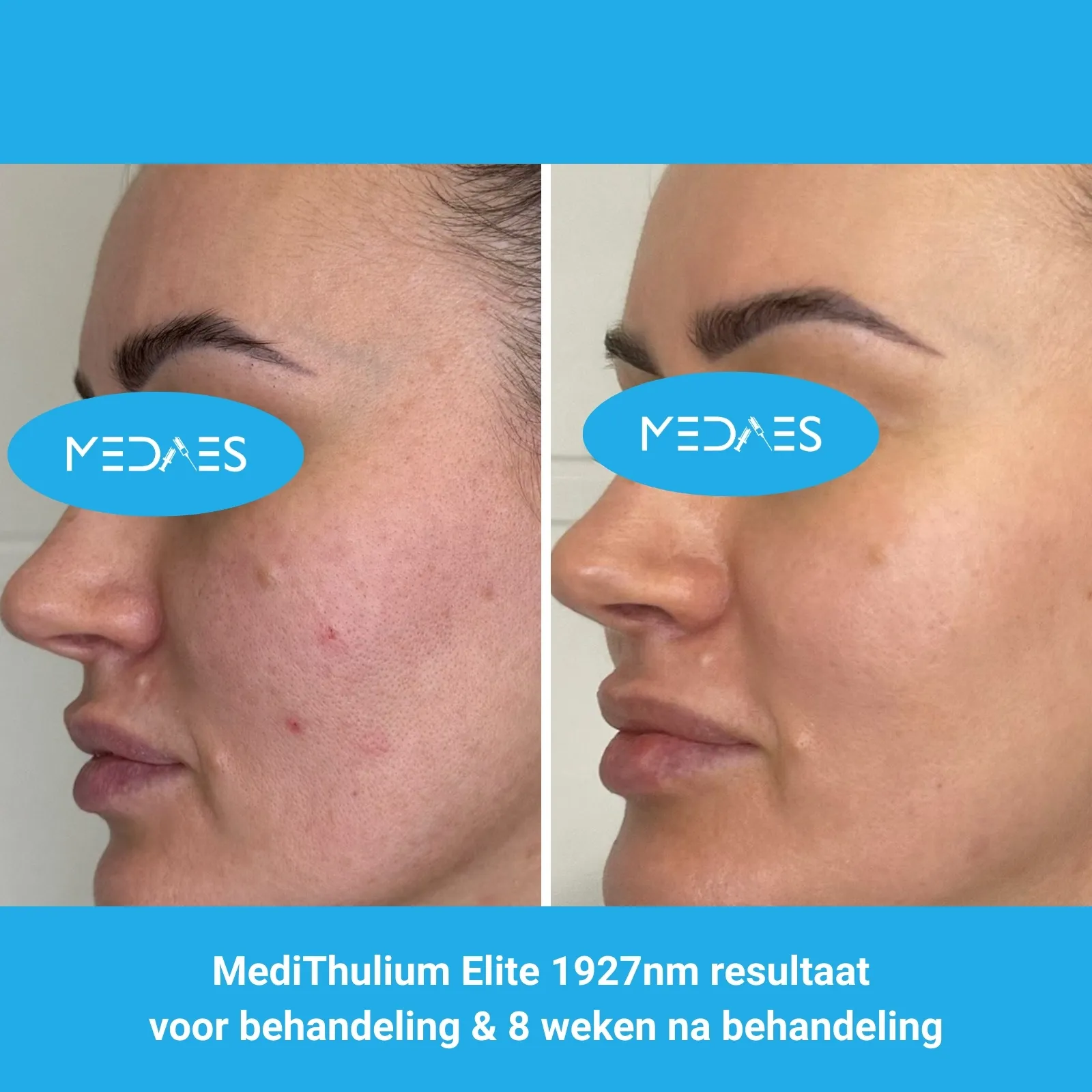 MediThulium Elite 1927nm van MedAesresultaat voor behandeling & 8 weken na behandeling