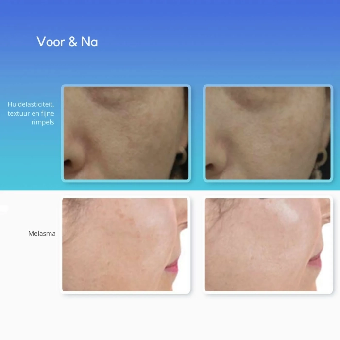 Resultaten Melasma en Rimpers MediThulium Elite 1927nm - Thulium laser -MedAes Europe