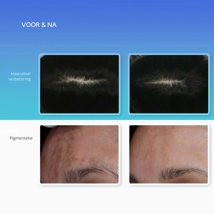 Resultaten haaruitval en pigmentatie met MediThulium Elite 1927nm - Thulium laser -MedAes Europe