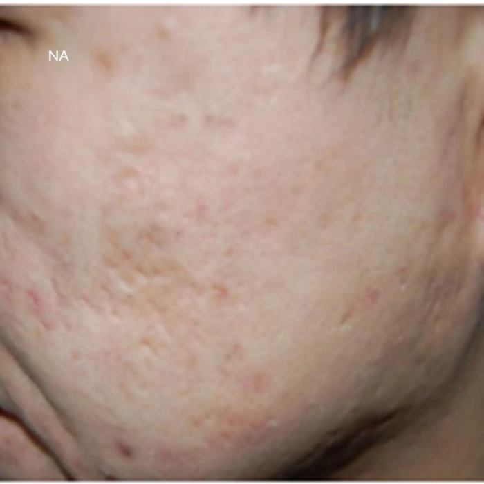 Resultaten pigmentatie met MediThulium Elite 1927nm - Thulium laser -MedAes Europe_na behandeling