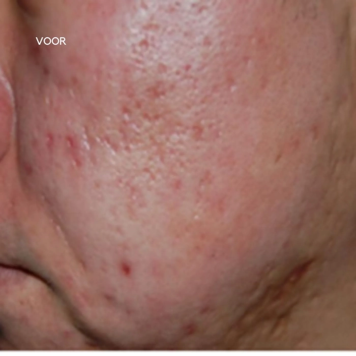 Resultaten pigmentatie met MediThulium Elite 1927nm - Thulium laser -MedAes Europe_voor behandeling