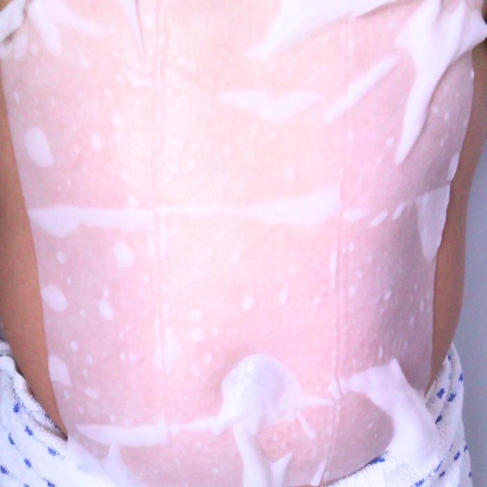 Antivries Membraan Cryopads – Vetbevriezing Bescherming met Cool Sculpting Pads in situatie