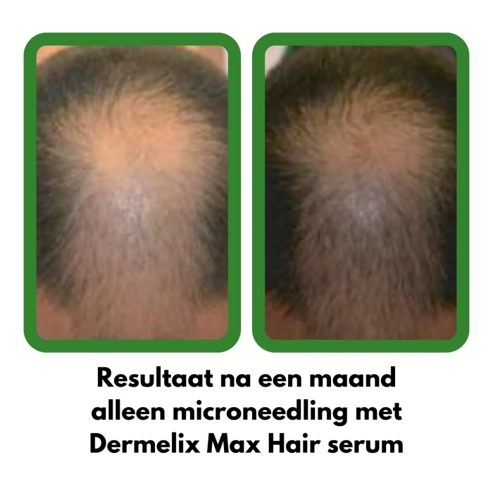 Dermelix CM-010 Minoxidil Spray 5% – 125 ml Resultaat na een maand alleen microneedling met Dermelix Max Hair serum