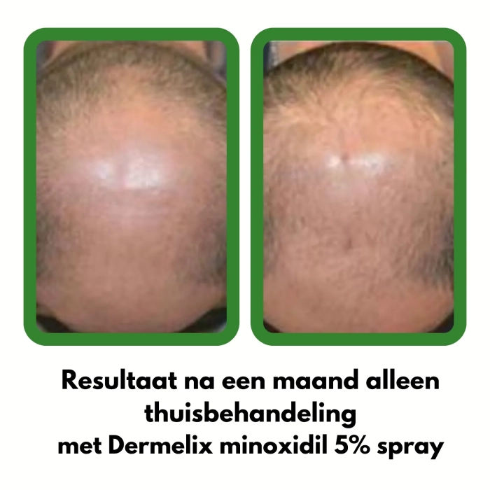 Dermelix CM-010 Minoxidil Spray 5% – 125 ml Resultaat na een maand alleen thuisbehandeling met Dermelix minoxidil 5% spray