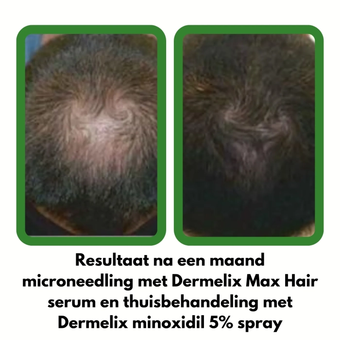 Dermelix CM-010 Minoxidil Spray 5% – 125 ml Resultaat na een maand microneedling met Dermelix Max Hair serum en thuisbehandeling met Dermelix minoxidil 5% spray