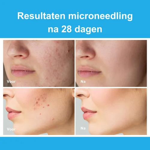 Dr. Pen A11 draadloze dermapen voor microneedling resultaten