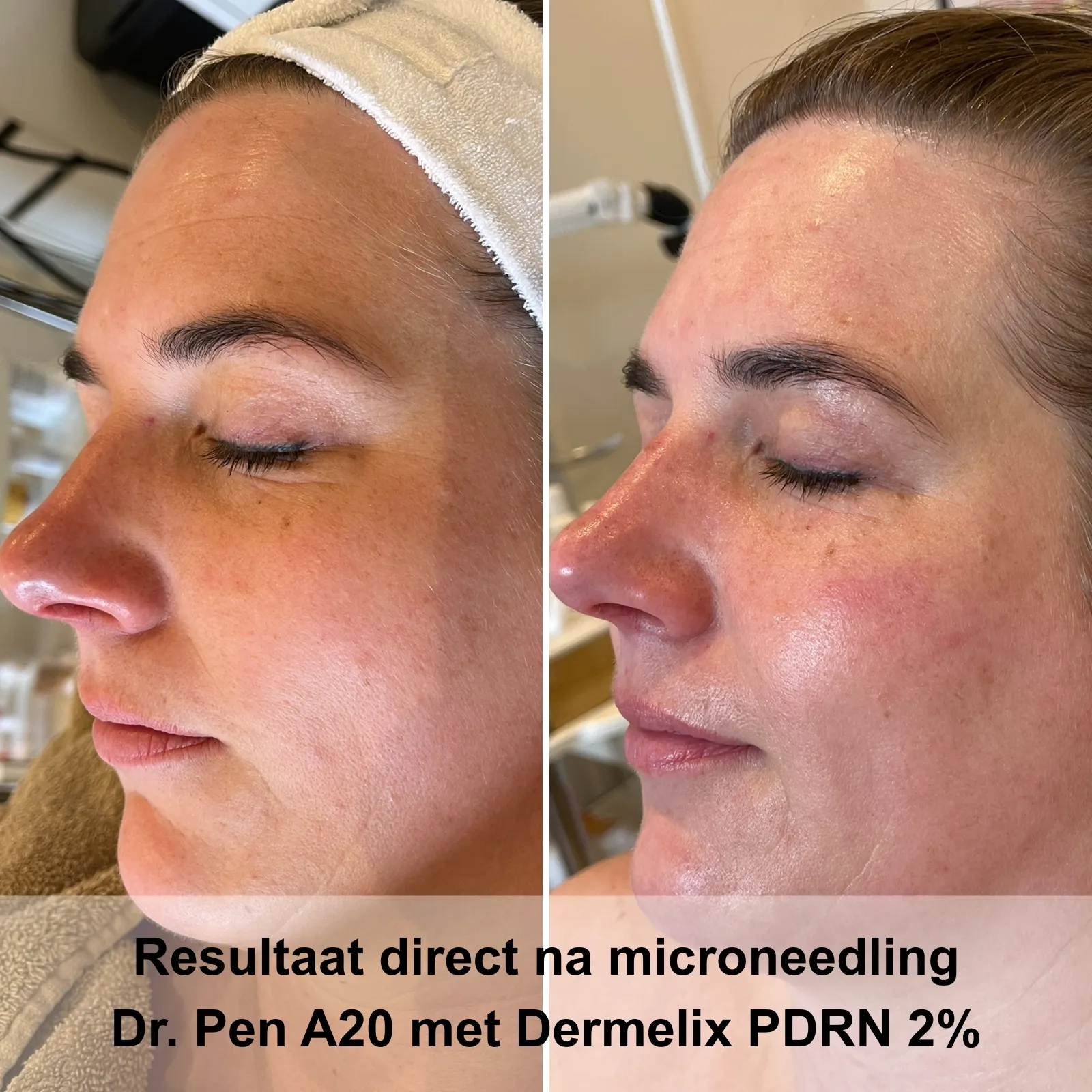 Resultaat direct na microneedling Dr. Pen A20 met Dermelix PDRN 2%